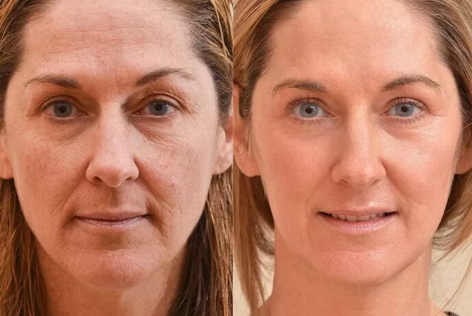 Rejuvenatioun vum Gesiicht virun an no