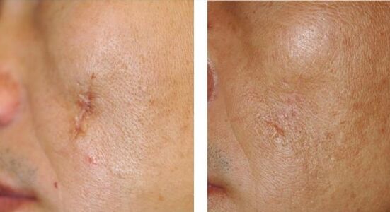 D'Resultat vum Laser
