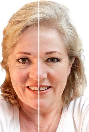 Rejuvenatioun vum Gesiicht