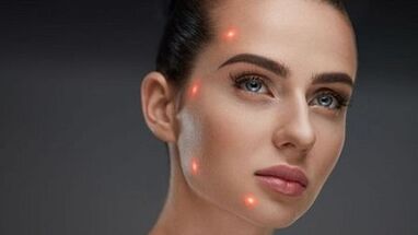 Wat ass fractional Haut Verjüngung