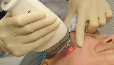 Wéi gëtt fractional Hautverjüngung gemaach