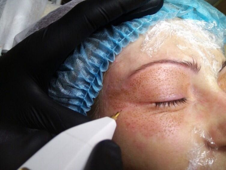 Plasma Lift Prozedur