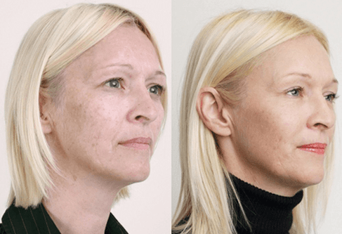 Mëttelméisseg Peeling mat Fruuchtsäuren
