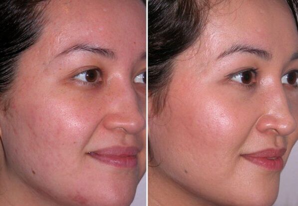 microdermabrasion natierlech